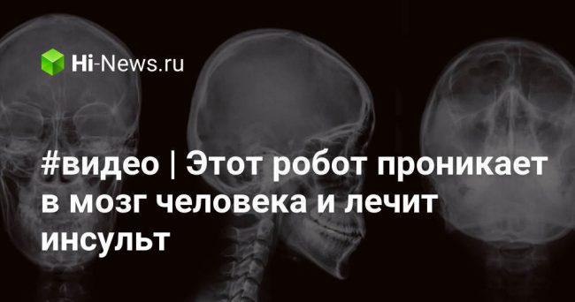 #видео | Этот робот проникает в мозг человека и лечит инсульт