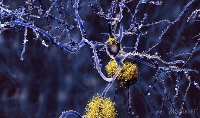 Естественная пульсация сосудов мозга может привести к предотвращению болезни Альцгеймера (2 фото)