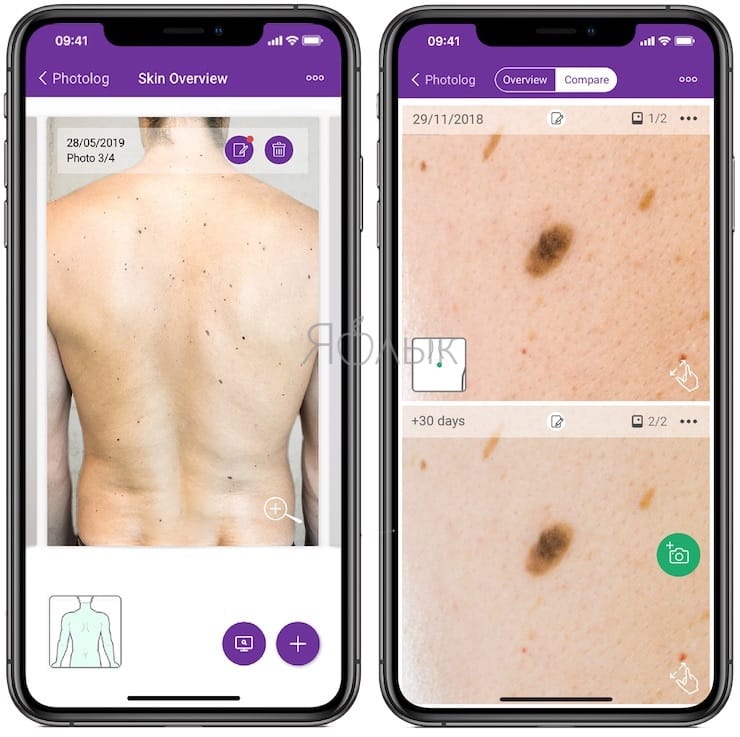miiskin - Как определять рак кожи с помощью смартфона?