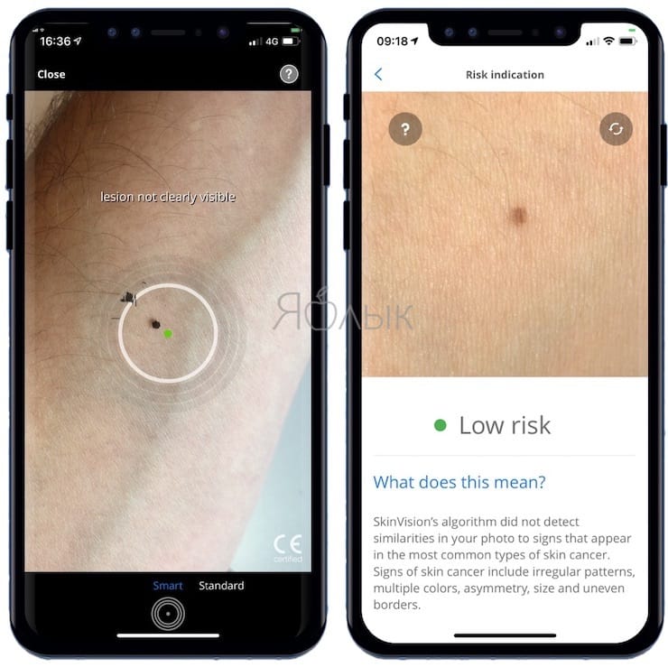 SkinVision - Как определять рак кожи с помощью смартфона?