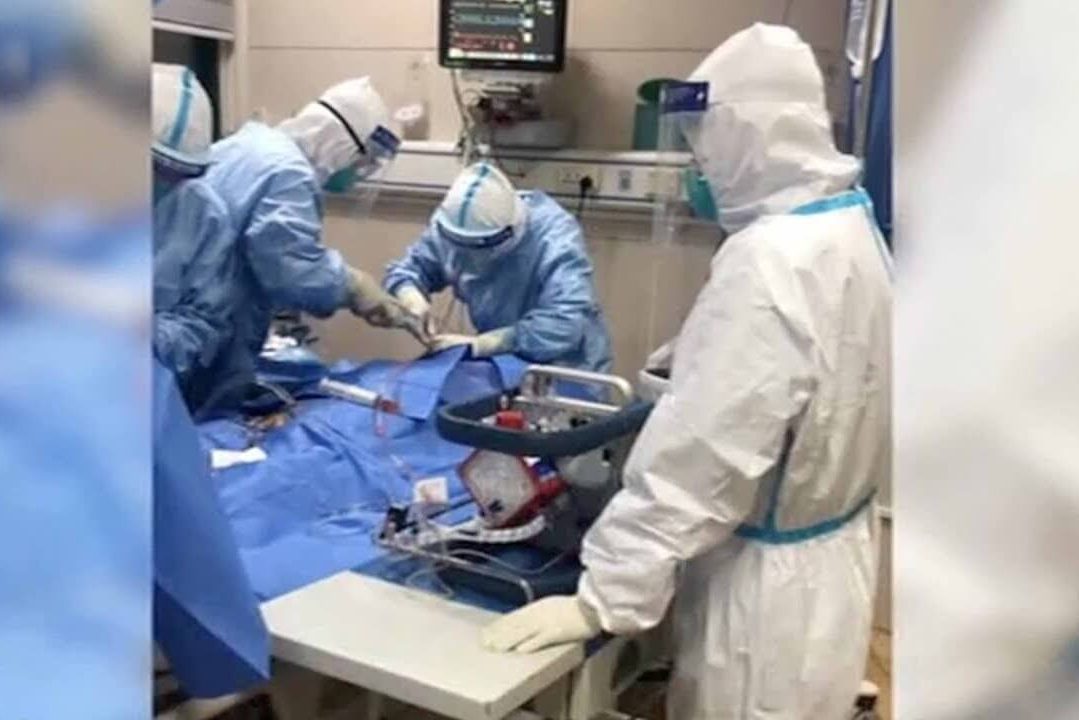 Что такое ЭКМО и чем отличается от ИВЛ?