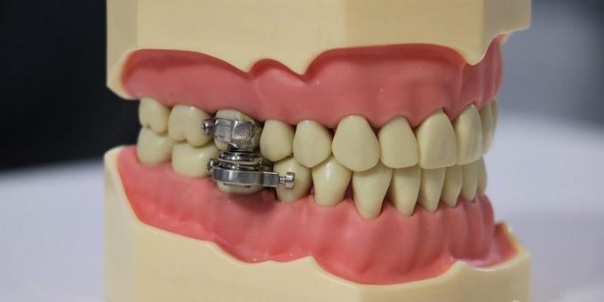 Электромагнитный замок внутри рта обеспечит эффективное похудение (2 видео) » 24Gadget.Ru :: Гаджеты и технологии