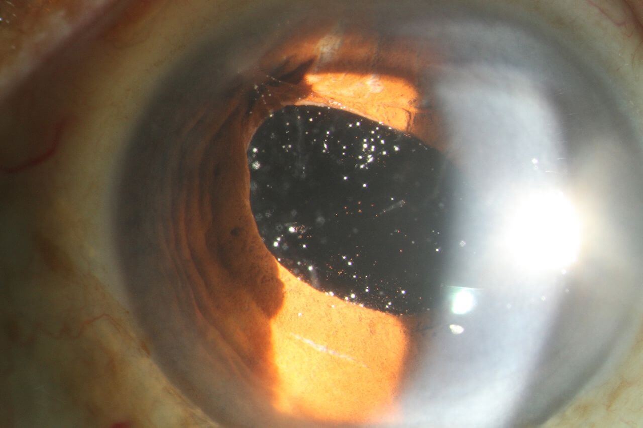 Что такое астероидный гиалоз. Глаз с астероидным гиалозом. Источник фотографии: researchgate.net. Фото.