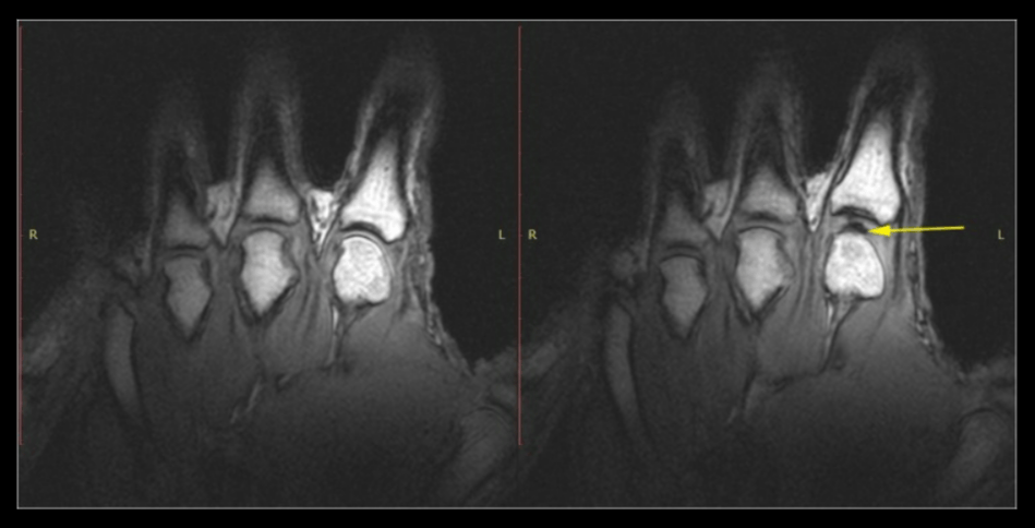 Почему хрустят суставы на самом деле. Слева: рука в покое перед растрескиванием. Справа: та же рука после хруста от растяжения. Обратите внимание на тёмную межсуставную полость (жёлтая стрелка). Источник изображения: pubmed.ncbi.nlm.nih.gov. Фото.